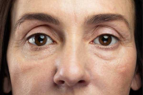 Remove under-eye bags permanently without surgery 1 bags